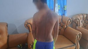 Seorang Anak di Limboto Barat Disiram Air Keras, Diduga Pelakunya Siswa SMA